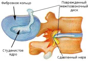 Грудной остеохондроз где болит