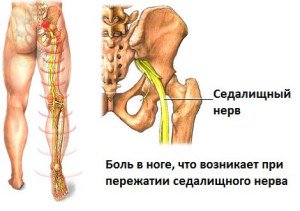 Ишиас лечение